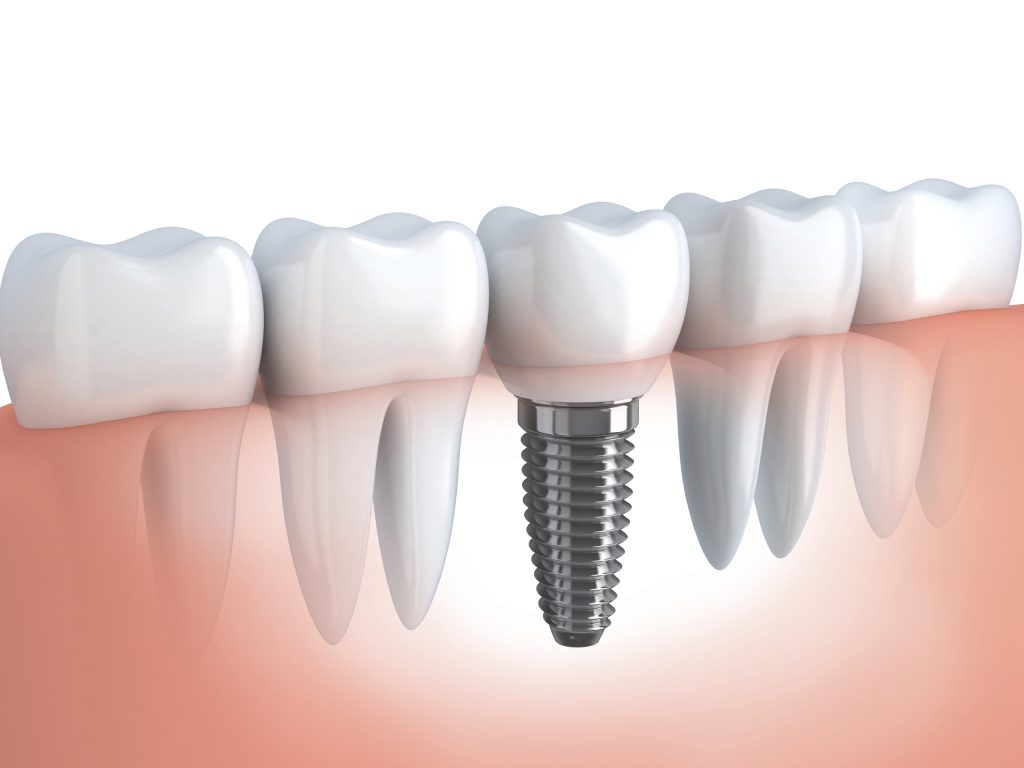 Do You Know the Biggest Advantage to Dental Implants?