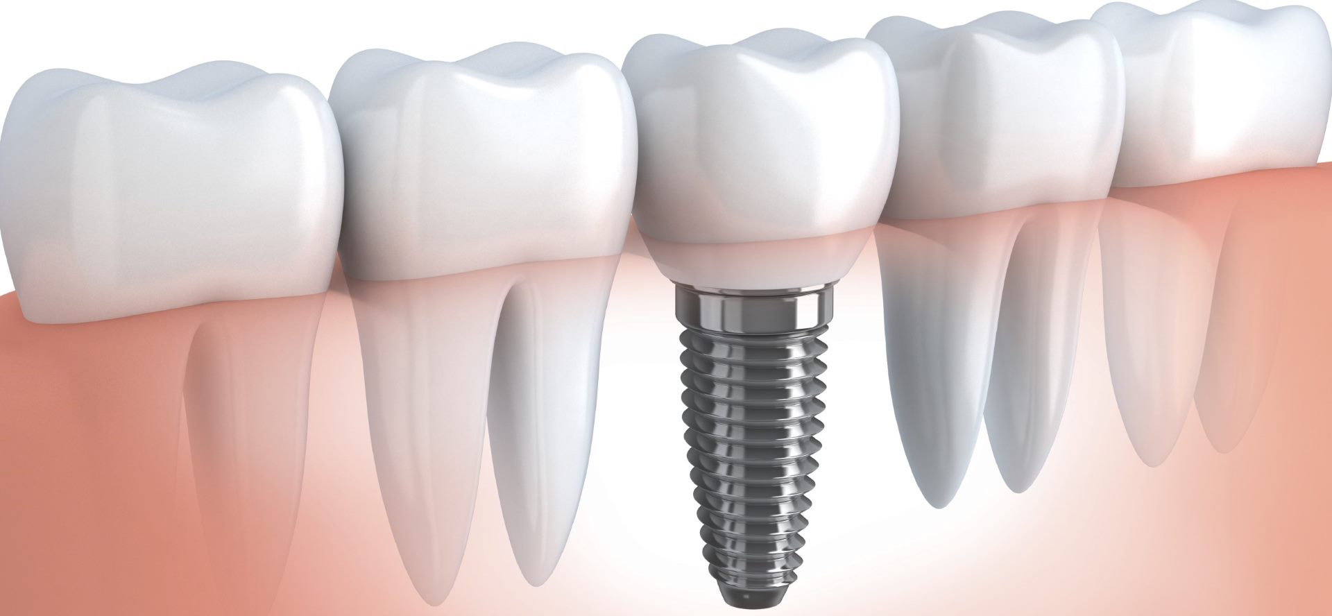 The Functions of a Dental Bridge