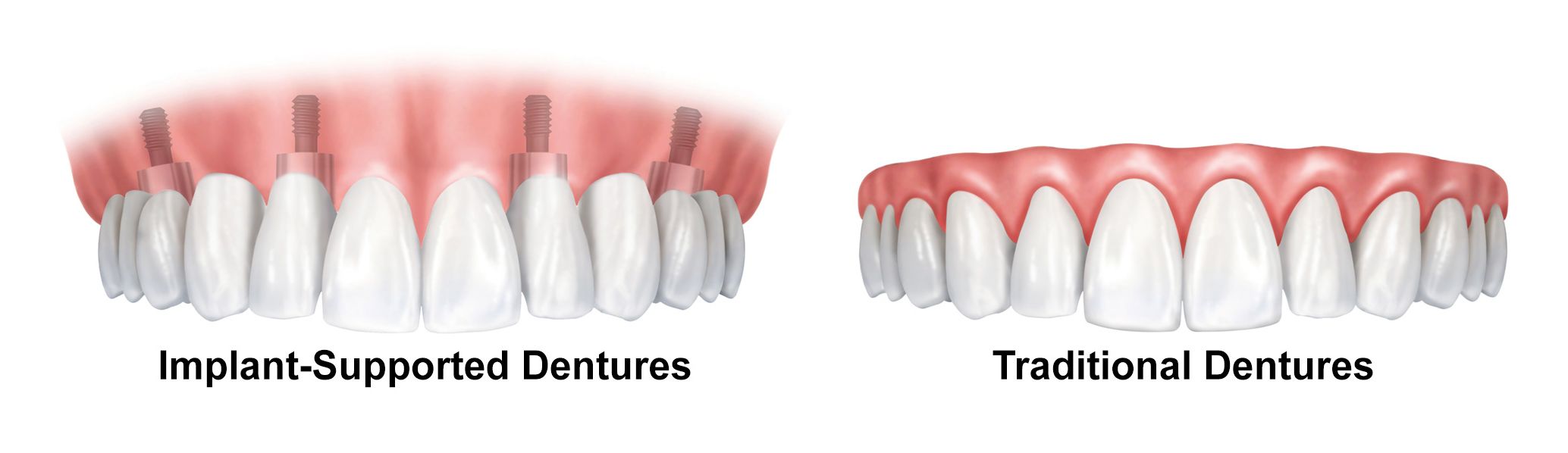 The Benefits of All-on-4® Implant Dentures