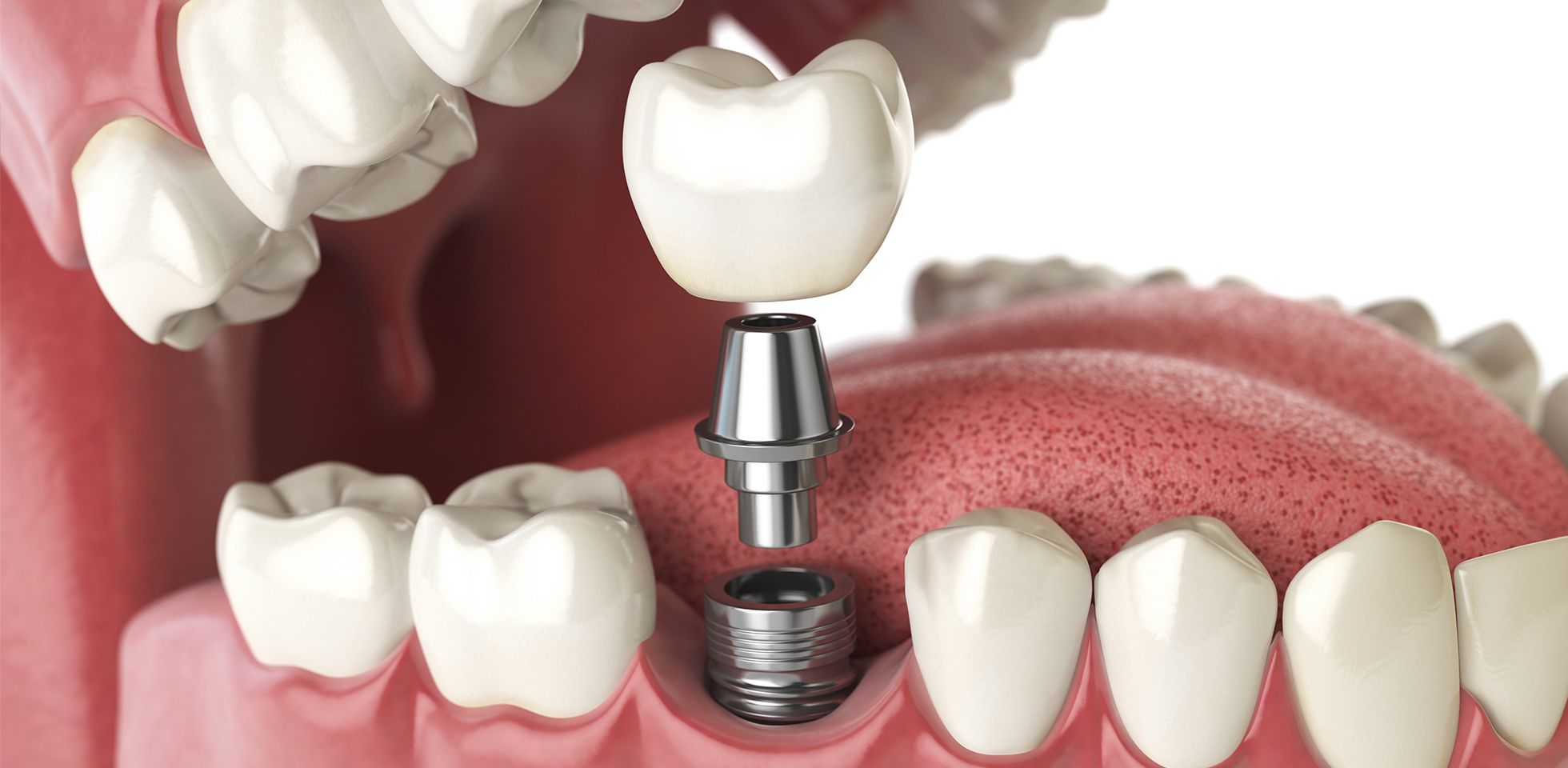 Lost a Tooth? Replace it with a Dental Implant and Crown