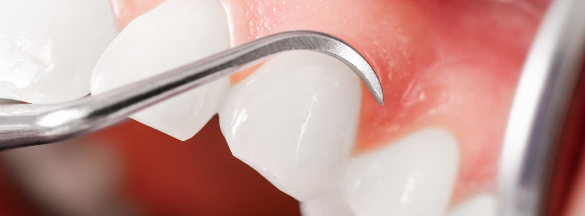 Highly-Rated Yuma AZ Dentist Talks About Gum Disease